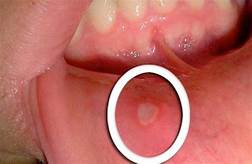 Comment enlever les aphtes facilement? 