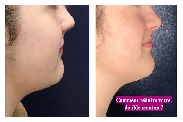 Comment réduire votre double menton ?