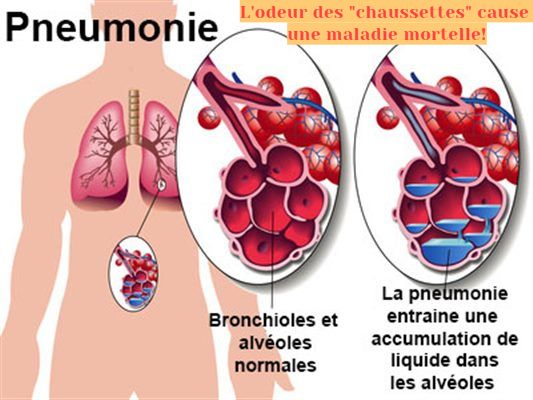 L'odeur des chaussettes cause une maladie mortelle L'odeur des "chaussettes" cause une maladie mortelle!