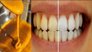 L'astuce la plus facile et efficace pour blanchir des dents