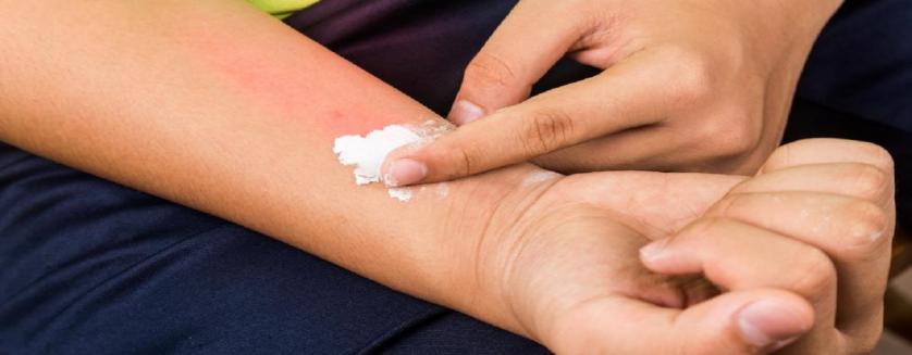 Le remède de magie pour soigner les piqûres d'insecte