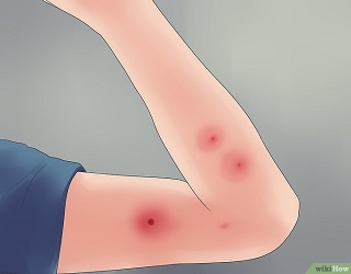 Le remède de magie pour soigner les piqûres d'insecte