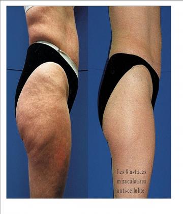 Le dépôt de graisse sous-cutané surtout au niveau les cuisses et les fesses chez les femmes en particulier, ça fait pas plaisir du tout.