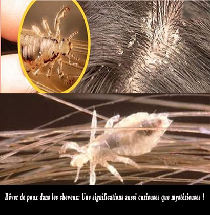 Rêver de poux dans les cheveux: Une significations aussi curieuses que mystérieuses !