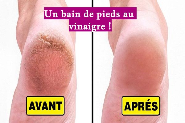 Un bain de pieds au vinaigre !