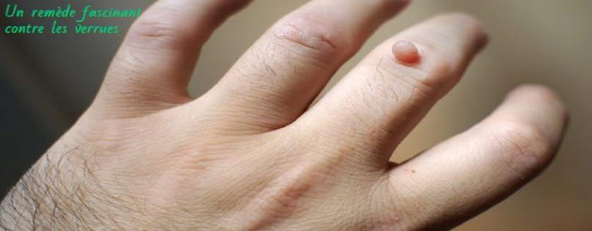 Un remède fascinant contre les verrues