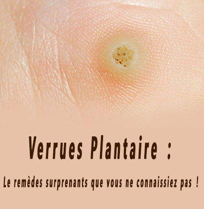 Verrues Plantaire : Le remèdes surprenants que vous ne connaissiez pas !