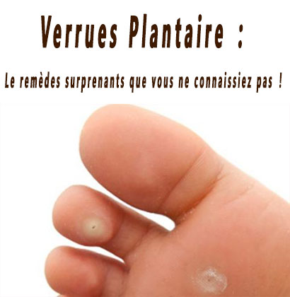 Verrues Plantaire : Le remèdes surprenants que vous ne connaissiez pas !