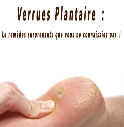 Verrues Plantaire : Le remèdes surprenants que vous ne connaissiez pas !