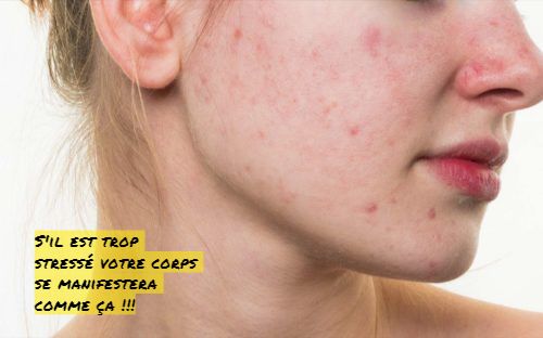 Les problèmes de peau S'il est trop stressé votre corps se manifestera comme ça