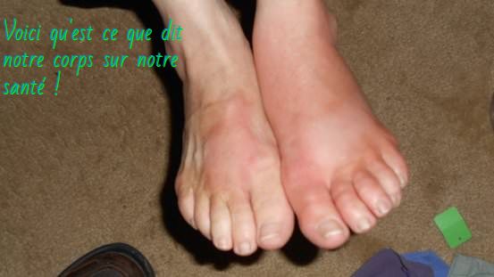Des pieds enflés Voici qu'est ce que dit notre corps sur notre santé