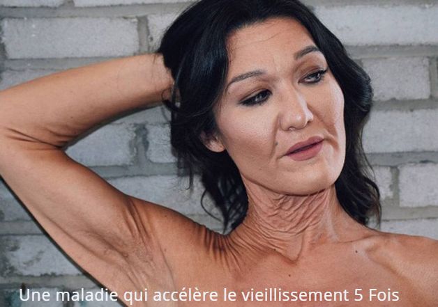 Une maladie qui accélère le vieillissement 5 fois Une maladie qui accélère le vieillissement 5 Fois !