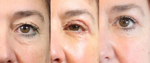 La chirurgie des yeux La blépharoplastie: la tendance chirurgies des yeux