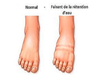 La rétention d'eau et les symptômes La rétention d’eau, les symptômes et la lutte ?