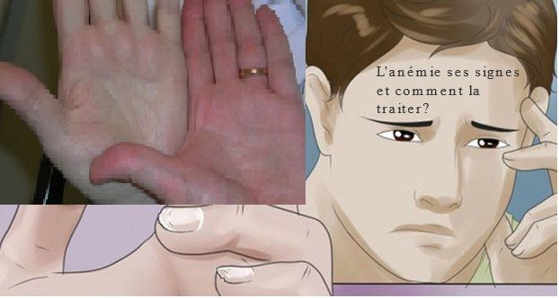 L'anémie ses signes et comment la traiter?