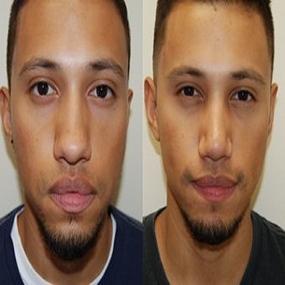 La rhinoplastie Les Hommes, demandeurs d’actes chirurgico-esthétique?