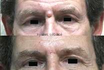Des Kystes graisseux Tout ce que vous devez savoir sur les kystes graisseux: