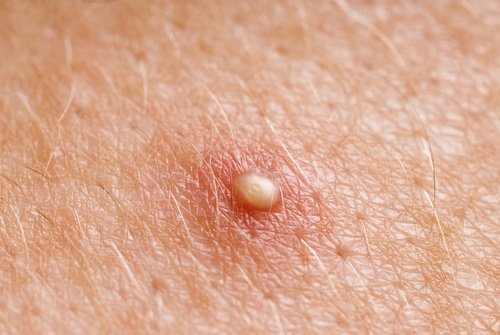 Des kystes graisseux Tout ce que vous devez savoir sur les kystes graisseux: