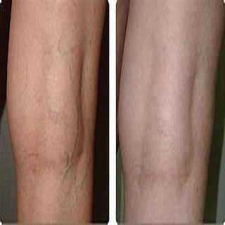 Traiter les varices naturellement