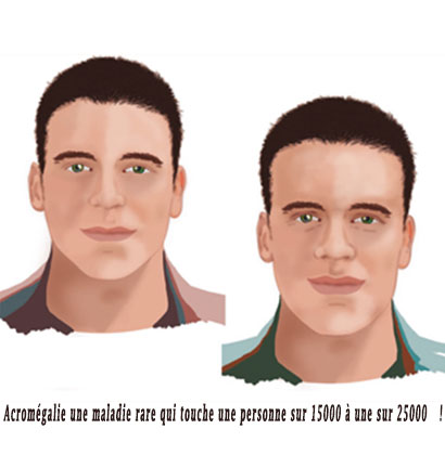 Acromégalie une maladie rare qui touche une personne sur 15000 à une sur 25000 !