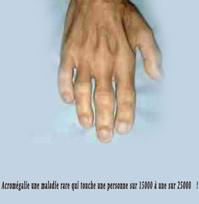 Acromégalie une maladie rare qui touche une personne sur 15000 à une sur 25000 !