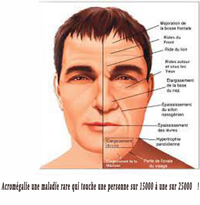 Acromégalie une maladie rare qui touche une personne sur 15000 à une sur 25000 !