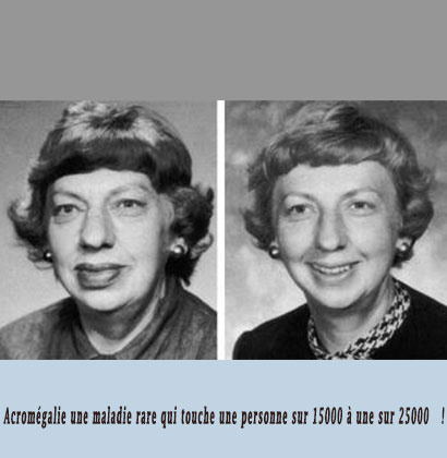 Acromégalie une maladie rare qui touche une personne sur 15000 à une sur 25000 !