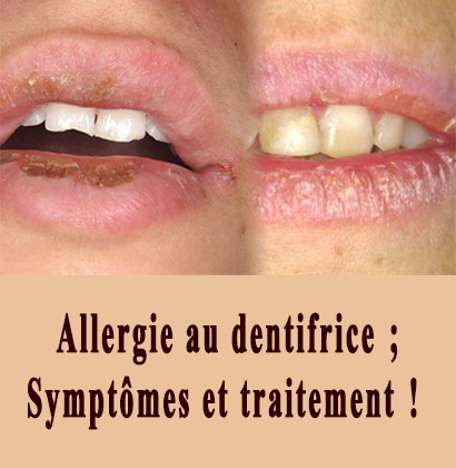 Allergie au dentifrice; Symptômes et traitement !