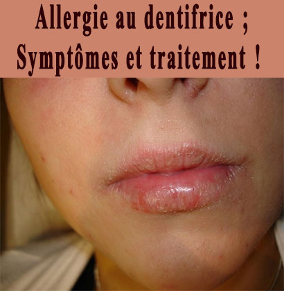 Allergie au dentifrice; Symptômes et traitement !