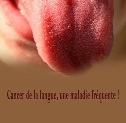 Cancer de la langue, une maladie fréquente !