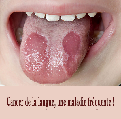 Cancer de la langue, une maladie fréquente !