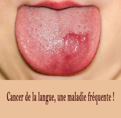 Cancer de la langue, une maladie fréquente !