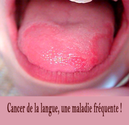 Cancer de la langue, une maladie fréquente !