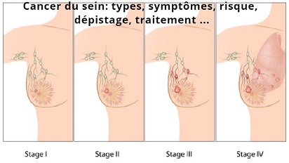 Cancer du sein: types, symptômes, risque, dépistage, traitement …