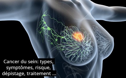 Cancer du sein: types, symptômes, risque, dépistage, traitement …