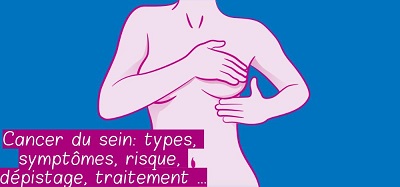 Cancer du sein: types, symptômes, risque, dépistage, traitement …