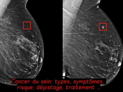 Cancer du sein: types, symptômes, risque, dépistage, traitement …