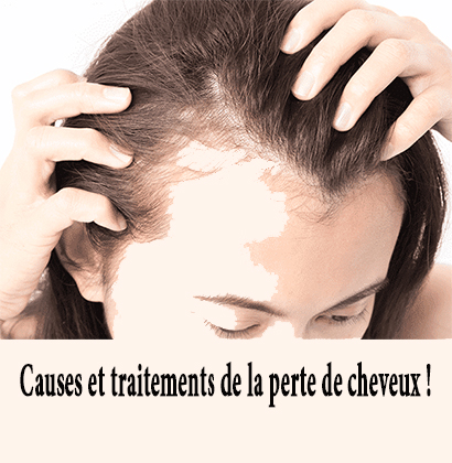 Causes et traitements de la perte de cheveux ! Causes et traitements de la perte de cheveux !