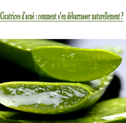 Cicatrices d’acné : comment s'en débarrasser naturellement ? Cicatrices d’acné : comment s'en débarrasser naturellement ?