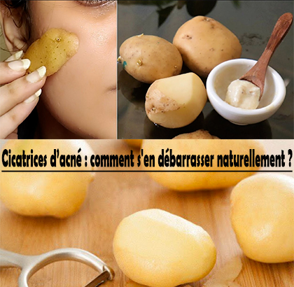 Cicatrices d’acné : comment s'en débarrasser naturellement ? Cicatrices d’acné : comment s'en débarrasser naturellement ?