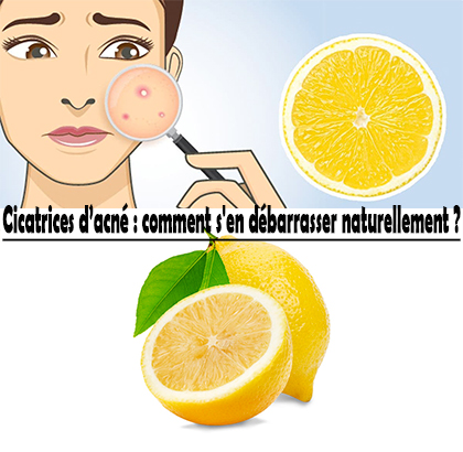 Cicatrices d’acné : comment s'en débarrasser naturellement ? Cicatrices d’acné : comment s'en débarrasser naturellement ?