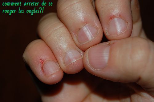 Comment arrêtez de se ronger les ongles Comment arrêtez de se ronger les ongles ?!!