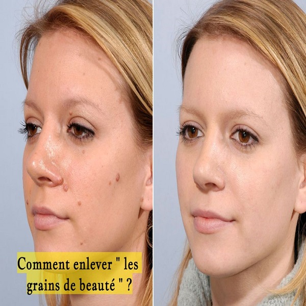 Comment enlever " les grains de beauté " ?