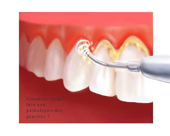 Comment réagir face aux pathologies des gencives ?