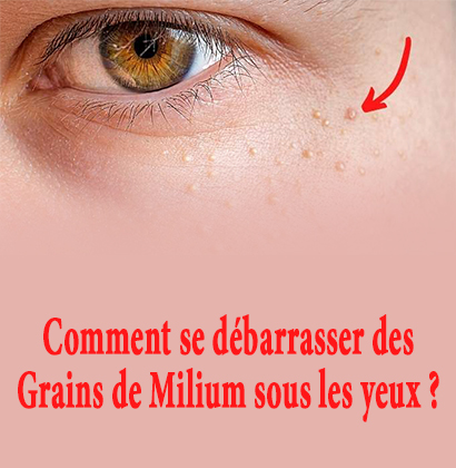 Comment se débarrasser des Grains de Milium sous les yeux ? 
