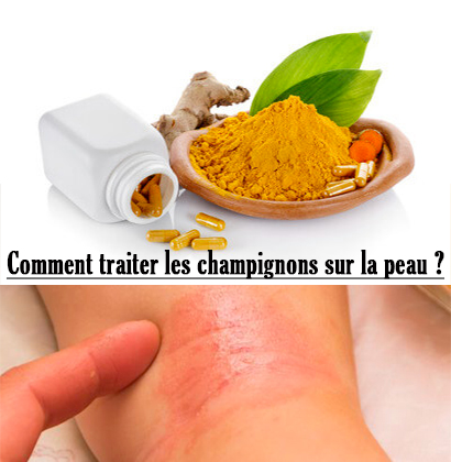 Comment traiter les champignons sur la peau ?