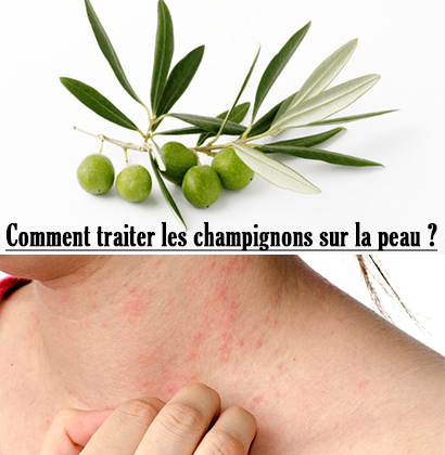 Comment traiter les champignons sur la peau ?