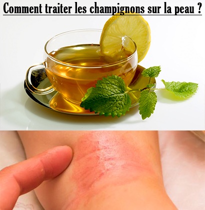 Comment traiter les champignons sur la peau ?