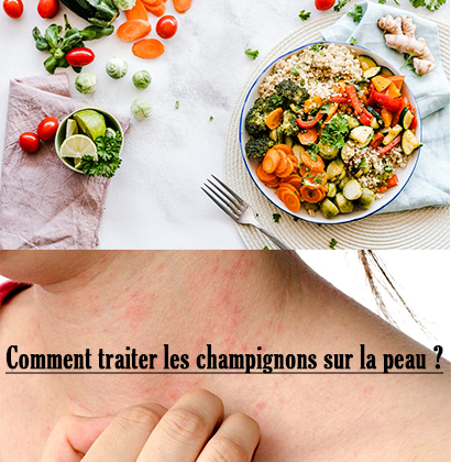 Comment traiter les champignons sur la peau ?