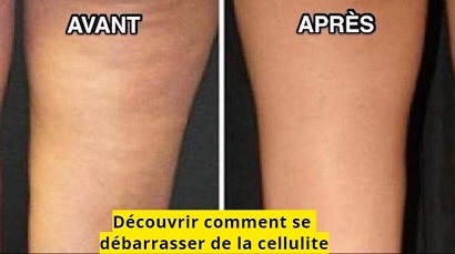 Découvrir comment se débarrasser de la cellulite
